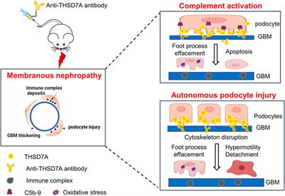 THSD7A-associated membranous nephropathy involves both complement-mediated and autonomous podocyte injury